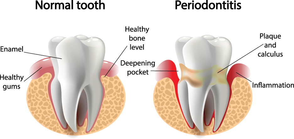 Periodontitis