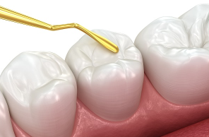 colored-fillings-procedure