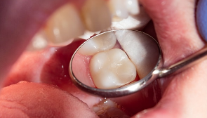 tooth-colored-fillings